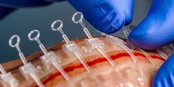 美國(guó)傷口拉鏈